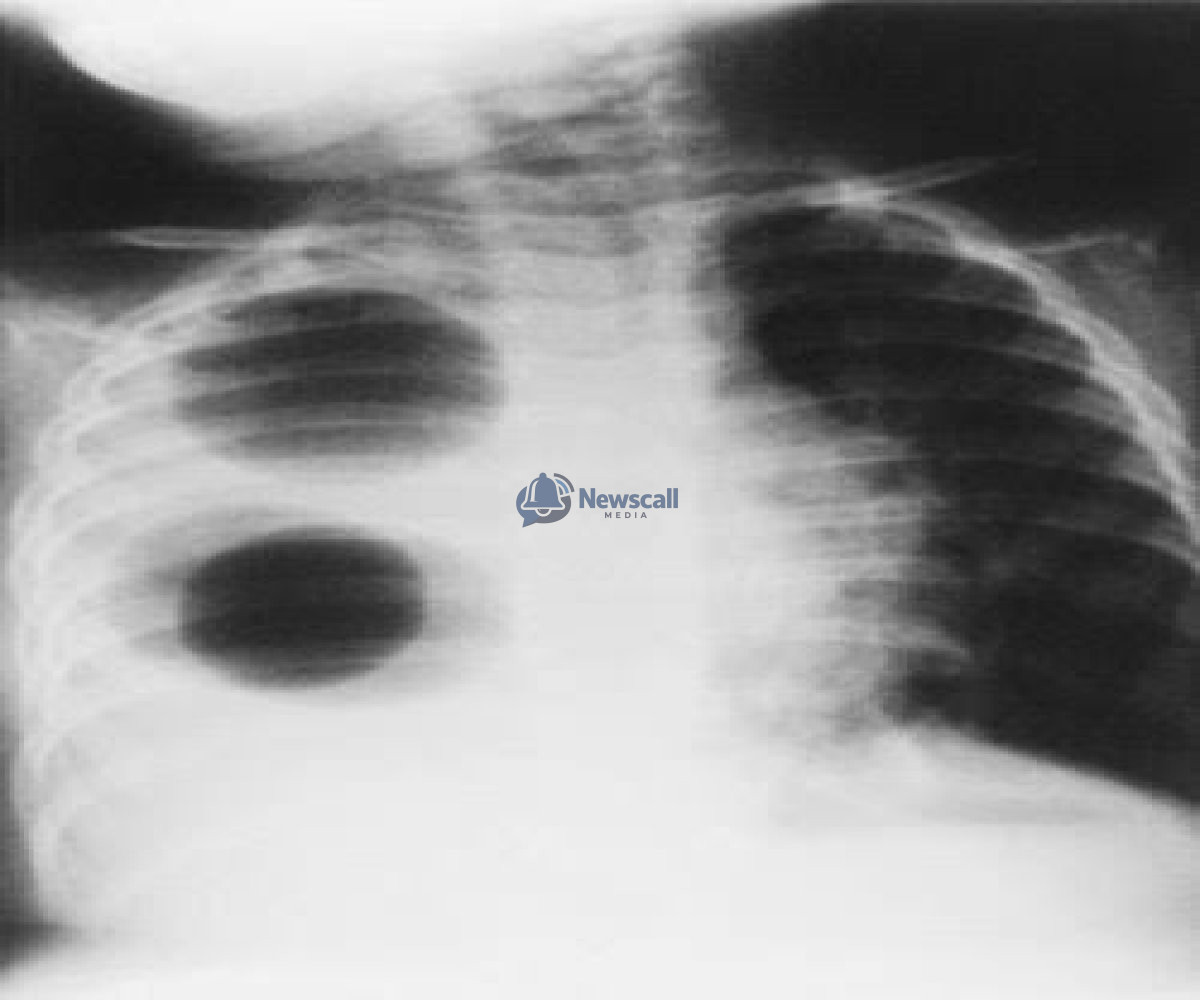 Born With One Lung: The Diagnosis Doctors Almost Always Miss